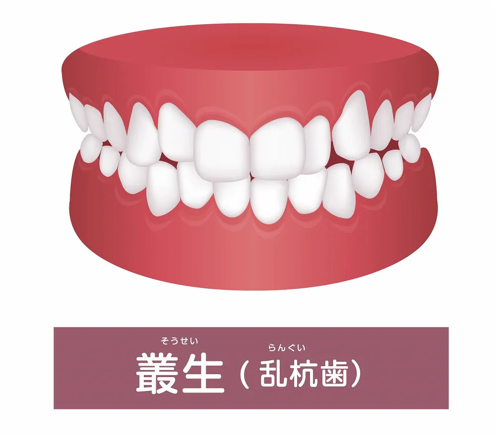 叢生（歯並びがデコボコ）でお悩みの方